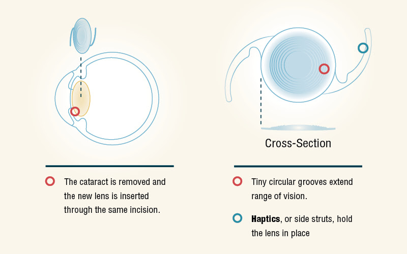 Tecnis Symfony: Raising the Standard for Cataract Surgery